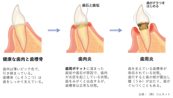 歯周病の進み方